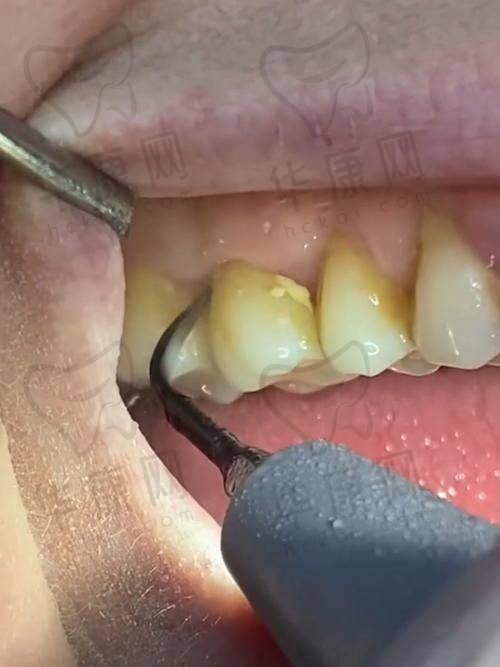 合肥佳德庐阳口腔舒适化喷砂洁牙的医院优势