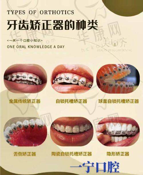 丽水缙云星耀口腔于仕林国产自锁矫正7999元起，复诊少效果好上班族优选