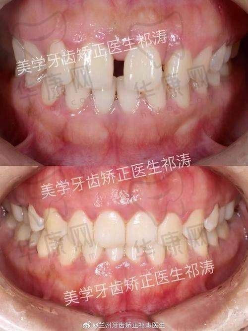 重庆美奥口腔医院刘洋时代天使隐形矫正之初诊体验
