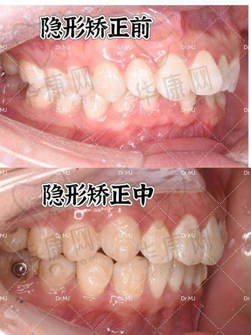 唐山壹颗芽口腔医生在隐适美隐形矫正方面的特色优势