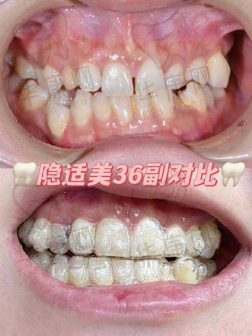 唐山壹颗芽口腔隐适美隐形矫正25722元起，老牌牙科技术稳服务佳！