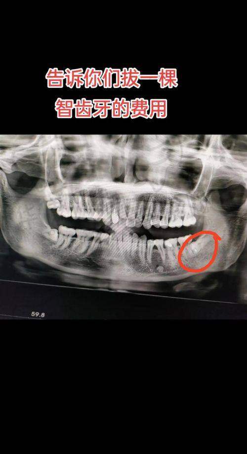 合肥佳德庐阳口腔下颌正位智齿拔除仅363元起，老牌机构正规诊疗超放心