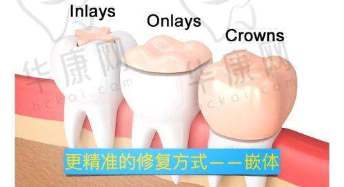 呼和浩特星耀口腔瓷嵌体补牙的制作工艺优势