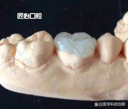 呼和浩特星耀口腔瓷嵌体补牙的牙齿情况考量