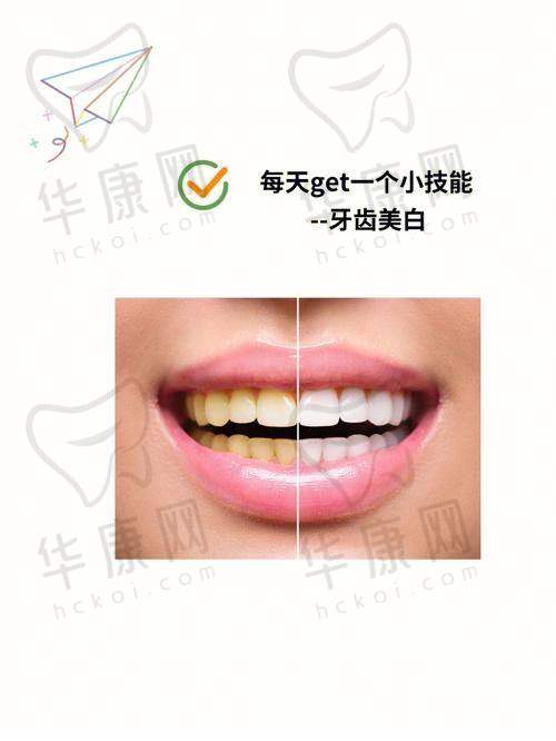 唐山壹颗芽口腔E-MAX全瓷贴面成功实例展示