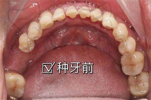 南通美特美口腔韩国奥齿泰种植牙2580元起/颗，高性价比之选超划算