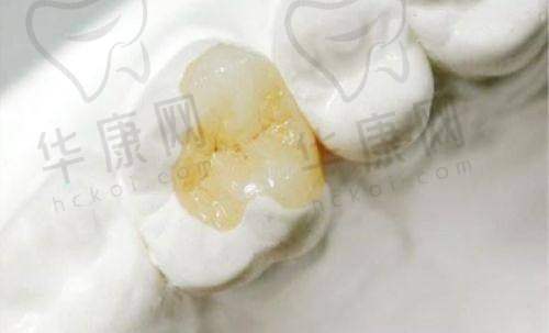 石家庄植美贝臣口腔3MZ350树脂补牙医生特色优势