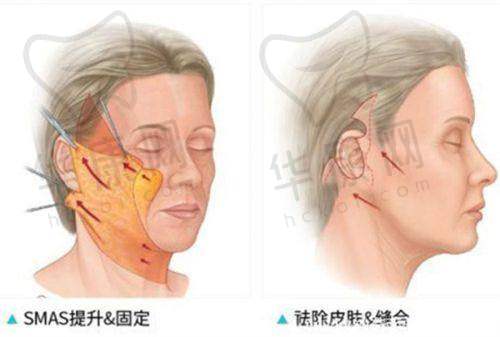 开封亿尚医疗美容荆志辉小眼综合的成功实例展示