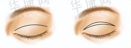 袁纯新医生双眼皮价格及预约方式