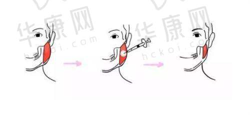 西宁韩美美容医院陈耿祛眼袋的患者评价