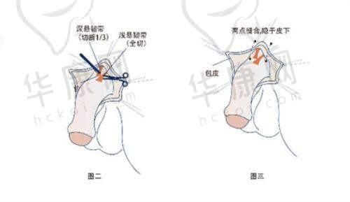 青岛城阳区诺美德医疗美容朗继春吸脂失败修复的维权建议