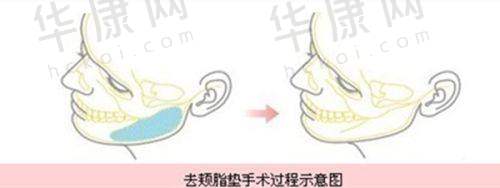 青岛城阳区诺美德医疗美容朗继春吸脂失败修复的经验教训