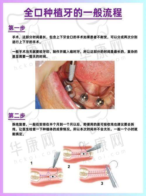 重庆南岸名博士口腔全口种植牙之术后修复