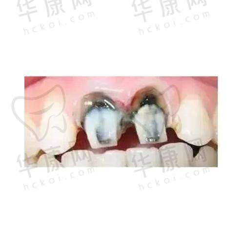 清远清城中泰口腔格莱美烤瓷冠559元起，实惠价享高品质牙冠修复！