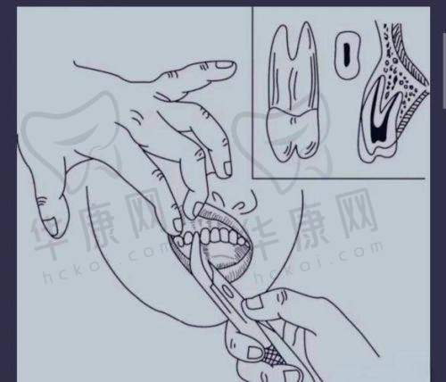 石家庄植美贝臣口腔医生在儿童乳牙拔除方面的优势
