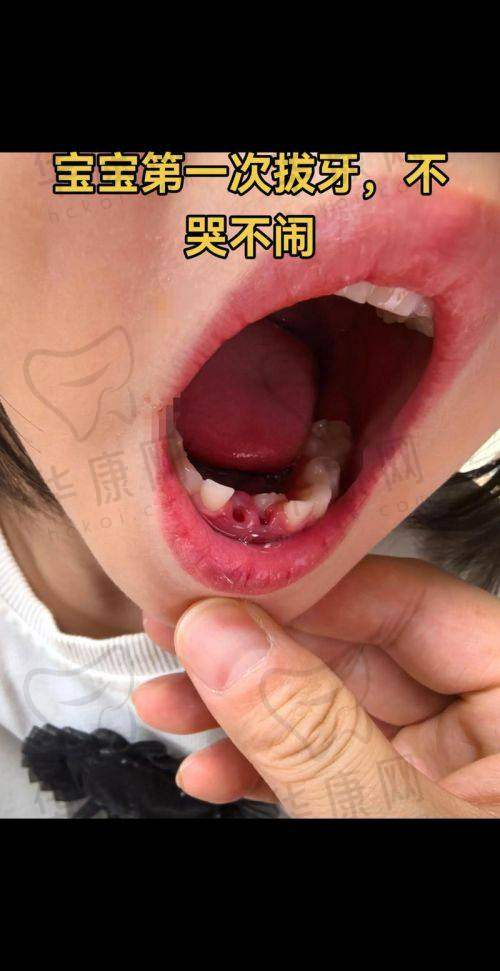 石家庄植美贝臣口腔在儿童乳牙拔除方面的特色优势