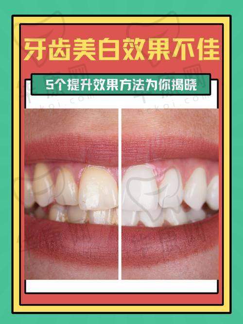 清远清城中泰口腔皓得适美白项目的服务优势