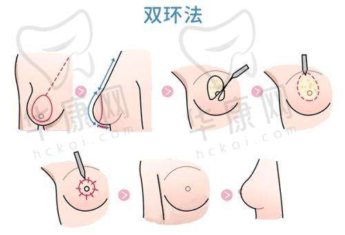 李世荣医生特色技术优势