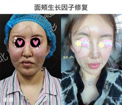 重庆米兰柏羽时光整形韦小勇半肋鼻综合与其他项目对比优势