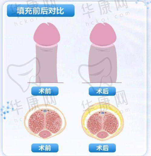 成都西区医院整形美容科宋华敬腹壁成形之精细缝合技术