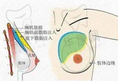 淮安华美整形张超吸脂之手术过程