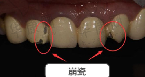 宁远雅美康口腔医院镍铬烤瓷牙的其他优势
