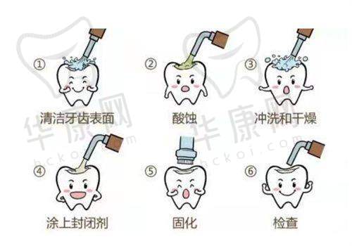 深圳善贝口腔儿童窝沟封闭150元起，专业防龋为孩子口腔健康保驾护航