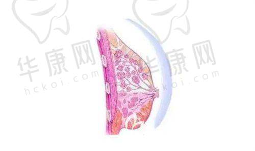 成都西区医院整形美容科宋华敬腹壁成形之个性化方案制定