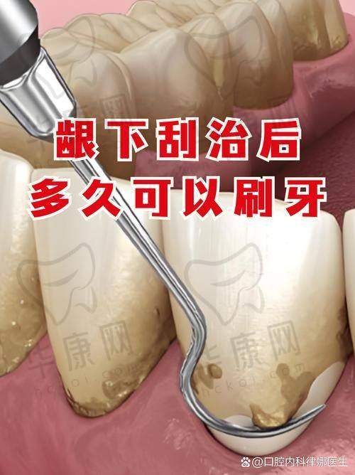 廊坊爱嘉口腔龈下刮治的服务特色