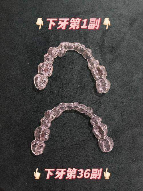 重庆德亚口腔刘亚新隐适美隐形矫正体验超棒，复杂牙问题轻松解决！