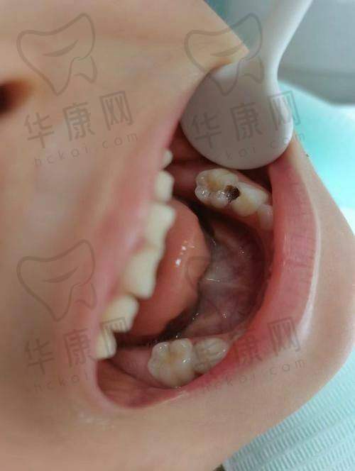 廊坊爱嘉口腔3M唯美树脂补牙的患者评价与口碑