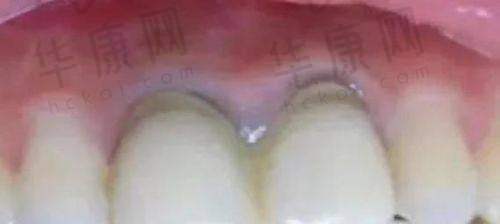 宁远雅美康口腔医院德国威兰德全瓷牙2860元起，优质材料与精湛工艺之选！