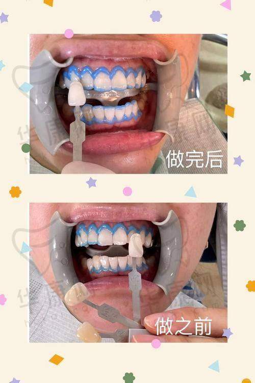 常熟明日口腔E-max全瓷贴面的医生优势