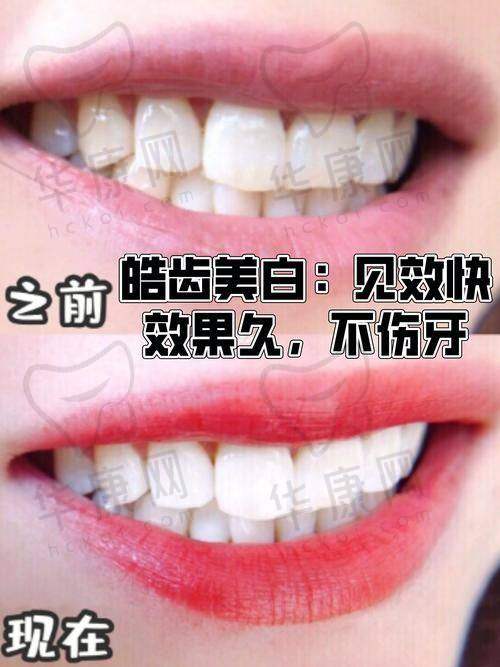 兰州诺贝尔口腔皓齿美白的成效保护