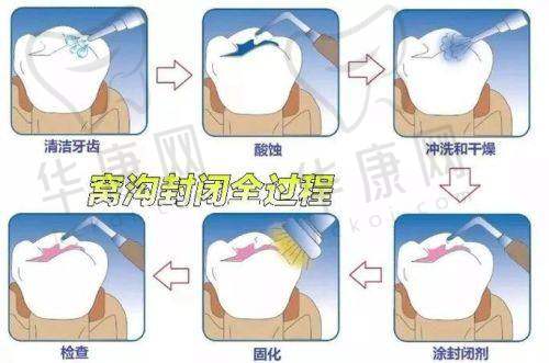 深圳善贝口腔儿童窝沟封闭的综合价值