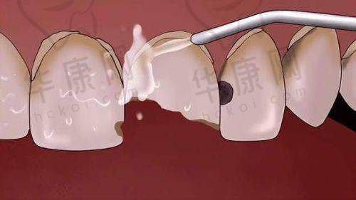 深圳善贝口腔医生在冠周冲洗方面的专精优势
