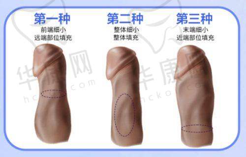 开封龙亭亿尚医疗美容荆志辉假体鼻综合之手术过程