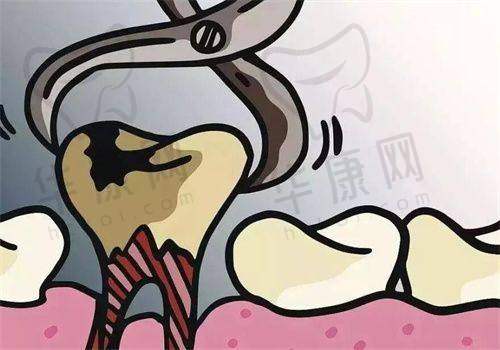 苏州英博口腔成人松动牙拔除仅60元起，低价高效解决牙齿松动难题！