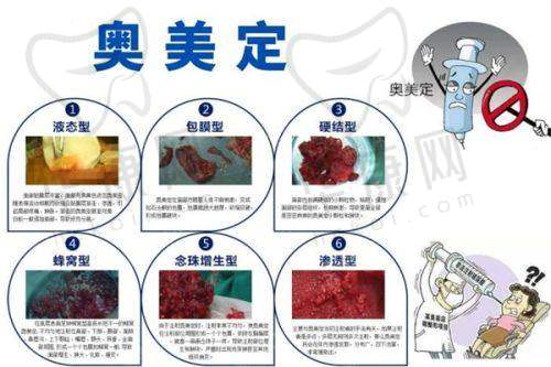 玻尿酸丰唇项目的注意事项