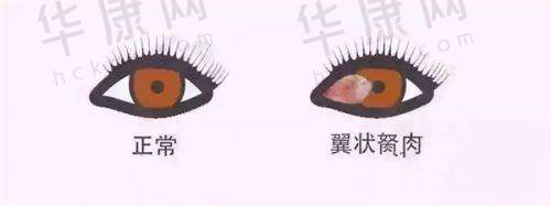温州眼科中 心做飞秒激光近视手术有啥优势？