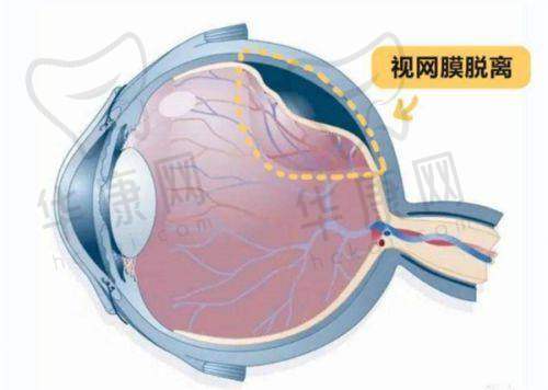 重庆星辉眼科三焦晶体58600元起，多焦点矫正方案解决近视老花散光！
