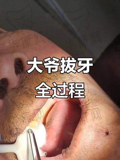 苏州赛阁中喜口腔上颌智齿拔除280元起，正规连锁收费透明超安心！