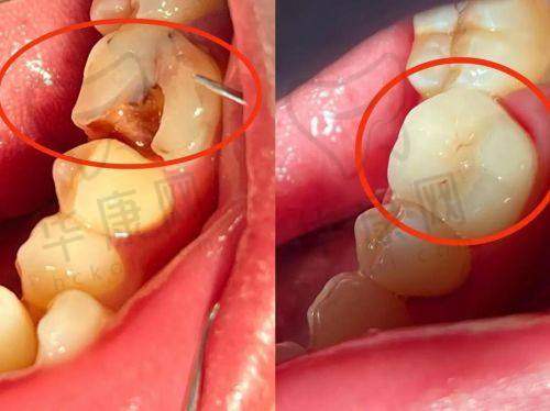 苏州英博口腔LAVA嵌体补牙与其他补牙方式对比
