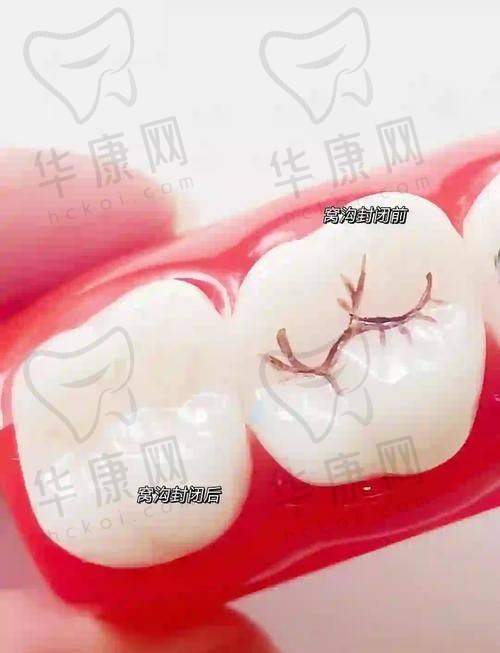 合肥泰康拜博口腔医院在儿童窝沟封闭项目的特色优势