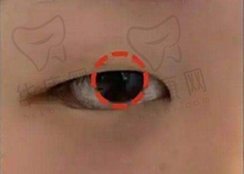 吸脂有哪些贴心小建议?