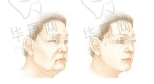 韩国做正颌手术好排名靠前的医院技术优势各异，正颌价格7万-12万不等
