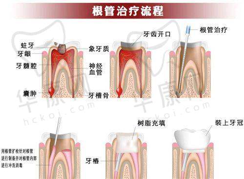 沈阳医博上诚口腔前牙根管治疗之初次就诊