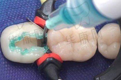 潍坊奎文华贝口腔德国VOCO补牙仅302元起，耐磨美观修复牙齿缺损超划算