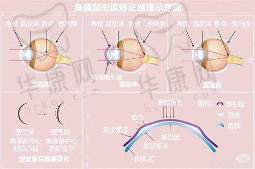 沧州爱眼医院眼科飞秒白内障手术的患者真实反馈
