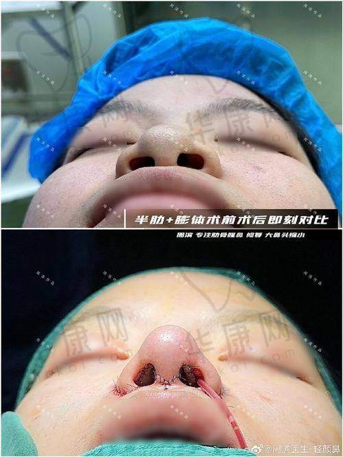 广州美莱医疗美容医院廖轶平鼻部整形的预约与注意事项